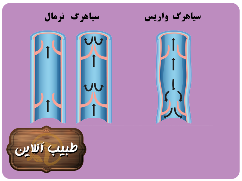 نقش سیاهرگ ها در واریس پا 