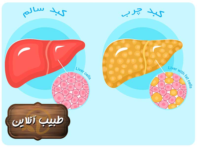 کبد چرب چه بیماری می باشد ؟